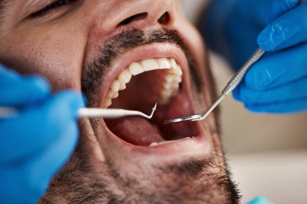 Best Emergency Treatment for Dental Infections or Abscesses in Princeton, FL